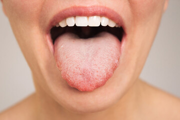 Caucasian woman opens her mouth and shows a sick tongue with teeth marks and a white plaque close-up. Endocrinology. Gastrointestinal diseases - obrazy, fototapety, plakaty
