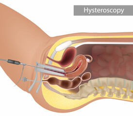 Anatomic illustration of a hysteroscopic procedure. Inspection of the uterine cavity by endoscopy. Hysteroscopy procedure