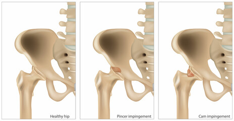 Illustration of the Femoroacetabular Impingement. Different of the Cam impingement and Pincer impingement. Healthy hip - obrazy, fototapety, plakaty
