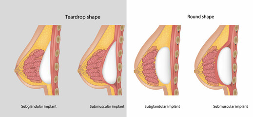 Subglandular and Submuscular Breast Implants. Implant shapes Teardrop shape and Round shape. Breast implant types. - obrazy, fototapety, plakaty
