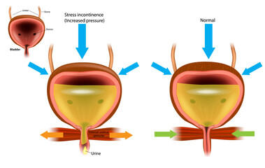 Overactive bladder OAB and Normal bladder.Illustration showing Detrusor muscle contracting when and before bladder is full. Urology - obrazy, fototapety, plakaty