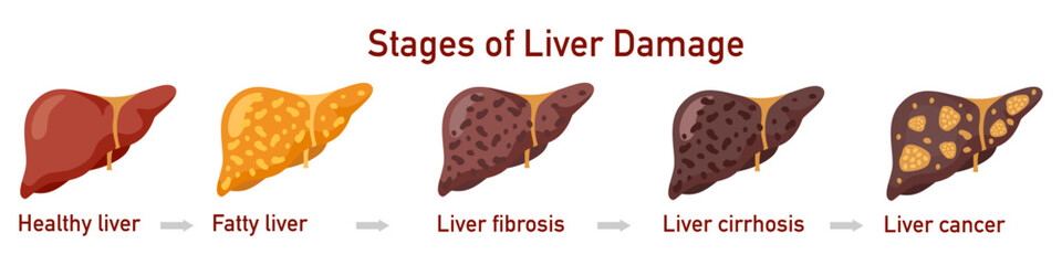Set of flat vector illustrations on the theme of medicine. Stages of liver diseases. . Vector illustration