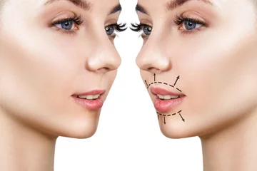 Fotobehang Woman lips before and after lip filler injections. © Galaxy_love_design