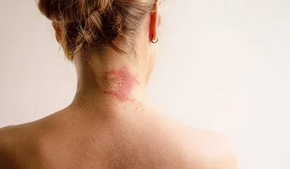 Manifestation of atopic dermatitis as a red itchy spot on a woman’s neck, close-up, rear view, copy space. Dermatology, allergy, itching, red spot or rash on skin © isavira