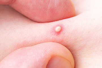 Pimple, acne or comedones. Inflamed pimples, pustules, cysts. Infection on skin. Popping pimple....