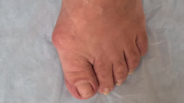 Valgus deformities. Flatfoot Orthopedic problem and disease