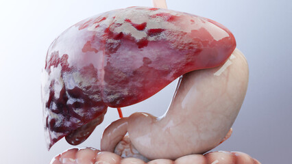 Digestive Organ Liver Cancer, Hepatitis cirrhosis malignant tumor, Hepatic failure, growing cells, duplicating, Fibrosis, Cirrhosis, Hepatocellular carcinoma, Virus infected liver, Human, 3d render