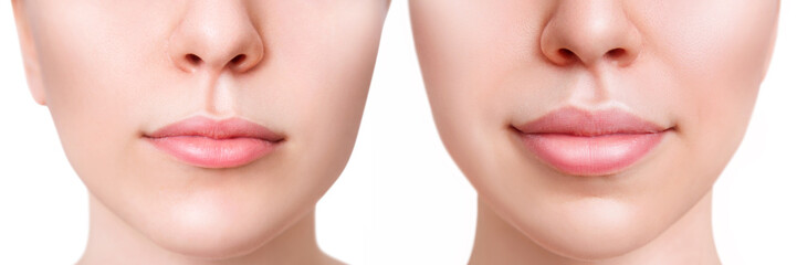 Female lips before and after augmentation procedure.