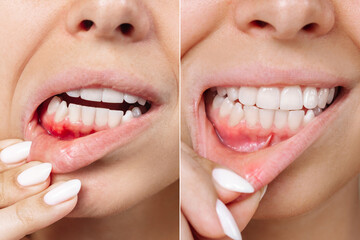 Two shots of a young woman with red bleeding gums and health gums before and after treatment. Result of curing of gum inflammation. Close up. Dentistry, dental care. Stomatitis, ulcer - obrazy, fototapety, plakaty