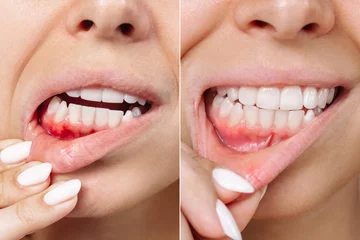 Deurstickers Two shots of a young woman with red bleeding gums and health gums before and after treatment. Result of curing of gum inflammation. Close up. Dentistry, dental care. Stomatitis, ulcer © Марина Демешко