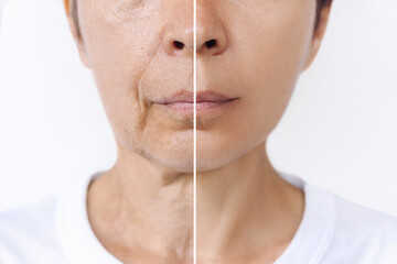 Lower part of face and neck of elderly woman with signs of skin aging before after plastic surgery. Age-related changes, flabby sagging skin, wrinkles, creases, puffiness. Rejuvenation, facelift - obrazy, fototapety, plakaty