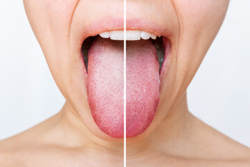 Female tongue with a white plaque. Comparison of a diseased tongue with a white plaque and a...