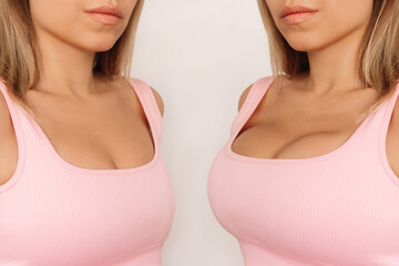 Young woman in pink top before and after breast augmentation with silicone implants. The result of a breast lifting. Breast size correction isolated on a light background. Plastic surgery concept