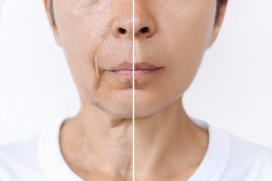 Lower Part Of Face And Neck Of Elderly Woman With Signs Of Skin Aging Before After Plastic Surgery. Age-related Changes, Flabby Sagging Skin, Wrinkles, Creases, Puffiness. Rejuvenation, Facelift