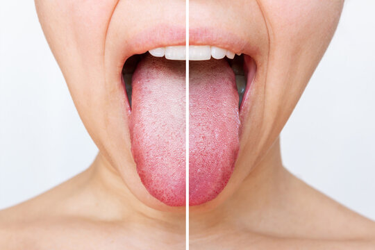 Female tongue with a white plaque. Comparison of a diseased tongue with a white plaque and a healthy clean tongue before and after treatment on a light background. The result of cleaning the tongue
