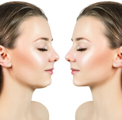 Young woman before and after chin correction. Over white background.