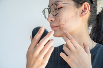 Young Asian woman worry about her face when she saw the problem of acne inflammation occur on her...