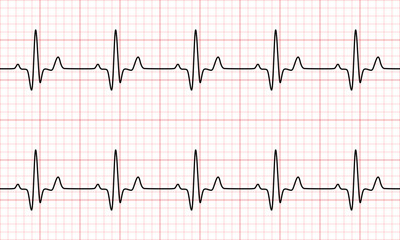Normal sinus rhythm from Electrocardiogram(EKG) heart graph. Vital Sign. Vector Medical Illustration.