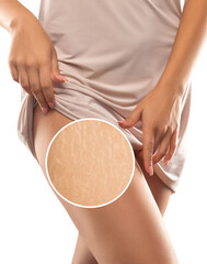 A woman after weight loss shows stretch marks on the skin of her legs and the outer and inner side...