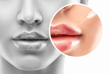 Injections for lips augmentation anti wrinkle injections on the face of a beautiful woman. Female...