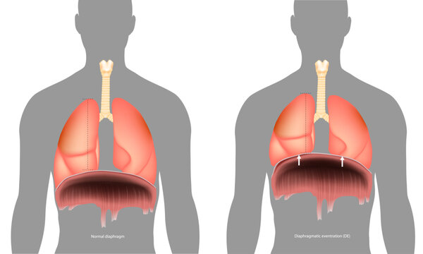 Normal diaphragm or Diaphragmatic eventration. Abnormal elevation of a portion or entire hemidiaphragm. Paralysis of the diaphragm