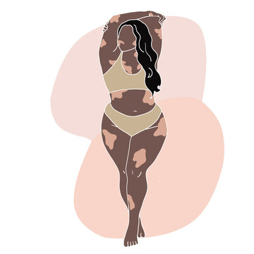 Vitiligo woman illustration