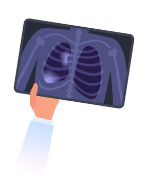 Healthy and collapsed lung x-ray image. Doctor`s hand holds MRI scan of partial closure of a lung. Respiratory failure, Atelectasis or pleurisy disease concept. Chest pain, lungs decrease illustration