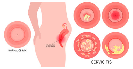 Cervical cancer and Pelvic inflammatory disease after bacteria infection with ovary vagina painful - obrazy, fototapety, plakaty