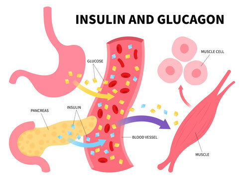 Type of Diabetes mellitus 1 and 2 with insulin injection diagram of chronic metabolism disease anatomy