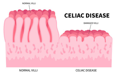 Ulcerative colitis for the small intestinal of Celiac disease with Stomach bacterial and Crohn's disorder that cause pain or fatty stools in medical - obrazy, fototapety, plakaty