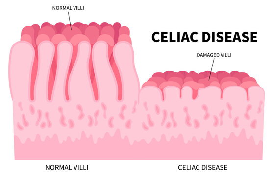 Ulcerative colitis for the small intestinal of Celiac disease with Stomach bacterial and Crohn's disorder that cause pain or fatty stools in medical