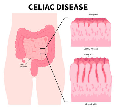 Anatomy of small intestinal and Crohn's disorder with Celiac disease the Bacterial in stomach that causes pain or fatty stools