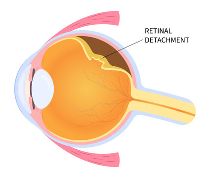 Eye blurred vision loss with floaters Myopia and detached retina after trauma injury of macular hole that tear or torn which lead to pain in nearsighted