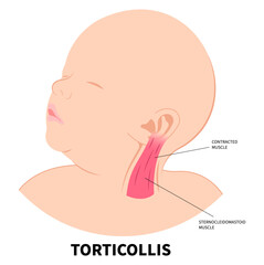 Neck muscle stiffness pain in adults or baby with chronic cervical dystonia disorder and the Torticollis of occupational therapy exercise - obrazy, fototapety, plakaty