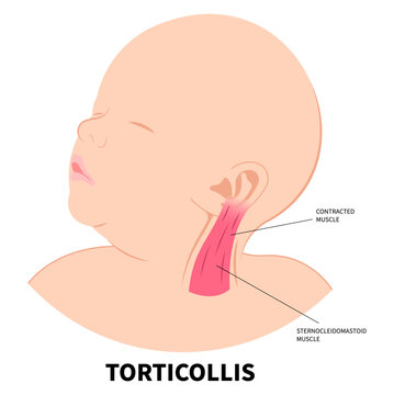 Neck muscle stiffness pain in adults or baby with chronic cervical dystonia disorder and the Torticollis of occupational therapy exercise