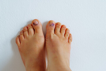 barefoot female feet with bruise on big toe nail due to tight uncomfortable shoes on white...