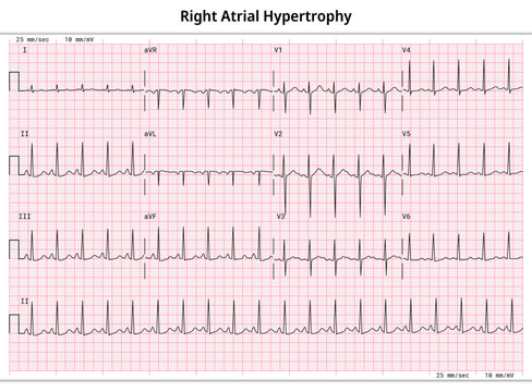 ECG Right Atrial Hypertrophy (RAH) - Right Atrial Enlargement (RAE) - 12 Lead ECG Common Case - 3 Sec per lead - Electrocardiogram Medical Vector Illustration