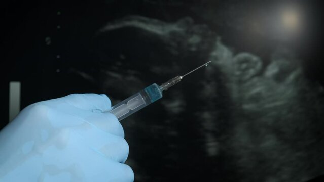 Gynecologist with syringe by ultrasound. A view of man gynecologist hand with syringe by the ultrasound screen. A concept of abortion and health woman care trouble.