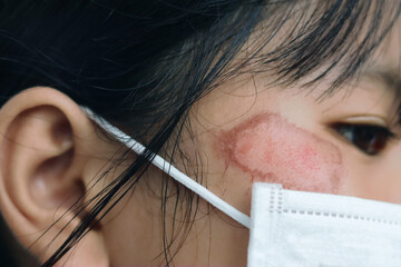 Abrasions on the face and skin that has almost disappeared.