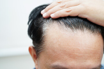 Bald head in man, hair loss treatment health problem. - obrazy, fototapety, plakaty