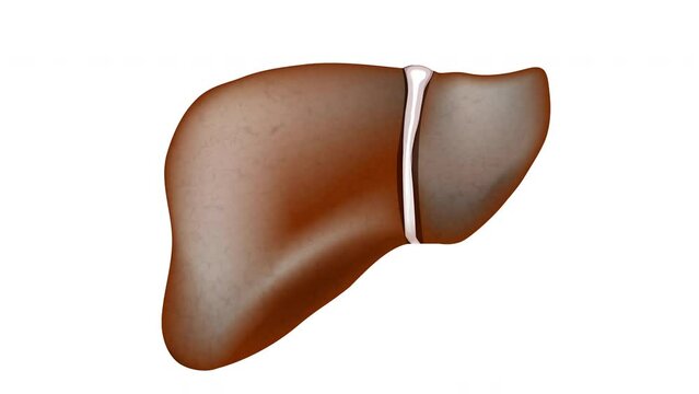 liver disease. How the liver changes during the disease from a healthy organ to Hepatic steatosis and cirrhosis. 
