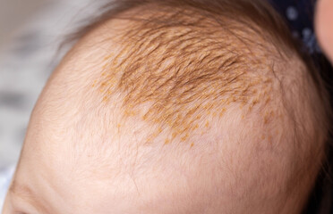 The process of formation of seborrheic dermatitis in an infant on the head. Scaly crusts, close-up - obrazy, fototapety, plakaty