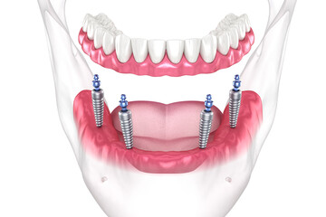 Mandibular removable prosthesis All on 4 system supported by implants with ball attachments. Medically accurate dental 3D illustration