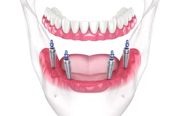 Fotobehang Mandibular removable prosthesis All on 4 system supported by implants with ball attachments. Medically accurate dental 3D illustration © Alex Mit