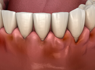 Gingivitis inflammation of the gums. Dental 3D illustration