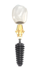 Dental implant and ceramic crown. Medically accurate tooth 3D illustration. - 677620490