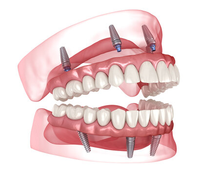 Dental prosthesis based on 4 implants. Dental 3D illustration