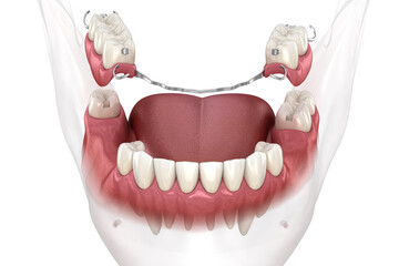 Removable partial denture, mandibular prosthesis. Medically accurate 3D illustration of prosthodontics concept - 677620865