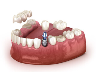 Tooth recovery with implant crown and bridge. Medically accurate 3D illustration dental concept. - 677621008