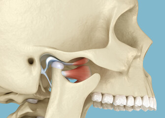TMJ: The temporomandibular joints dislocation. 3D illustration. - 677621097
